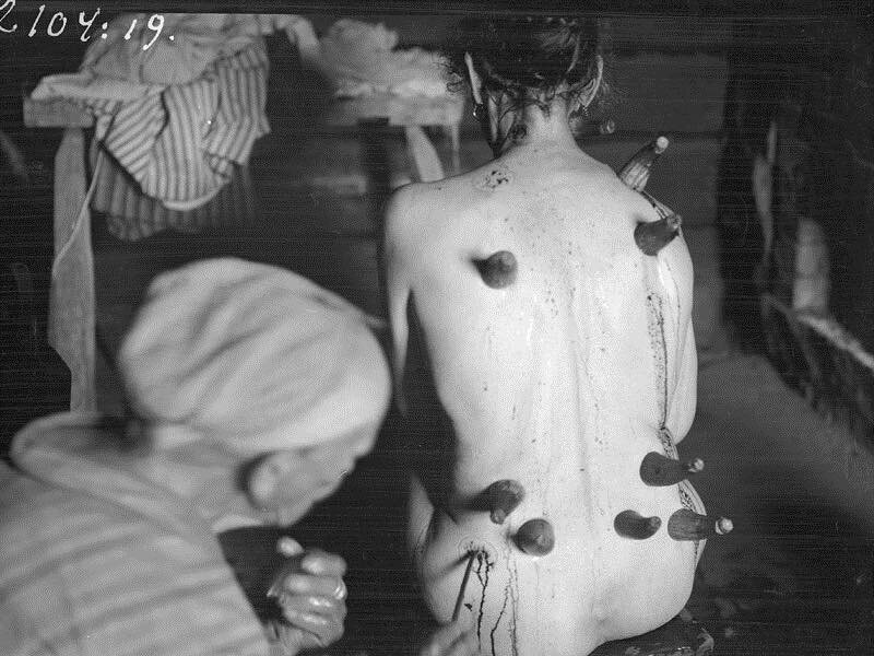 Subbing glass cups with horns will straight up make it look like something out of a horror movie. Queue dramatic lighting.
.
This is a picture of Finnish horn cupping, circa 1930s. It ain&rsquo;t just a fad!
.
The Fins used horns instead of glass cup