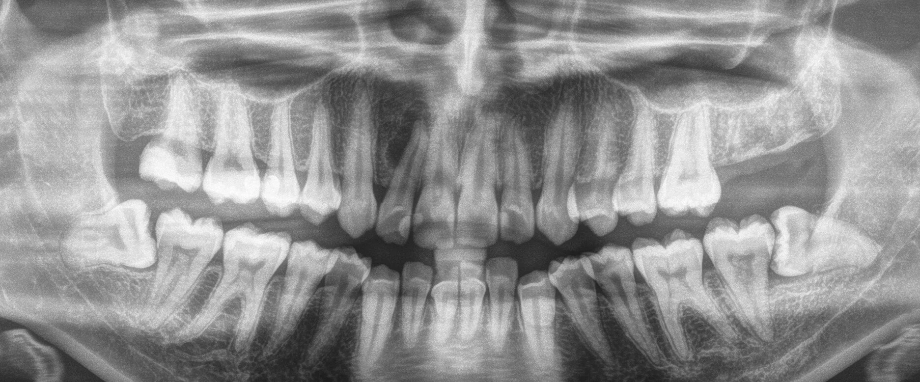 Wisdom tooth removal.jpg