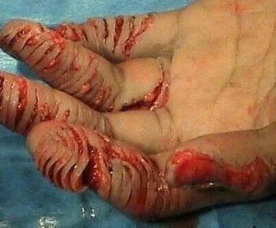 result of punishment inflicted in picture above: The blood of Jesus covers even this