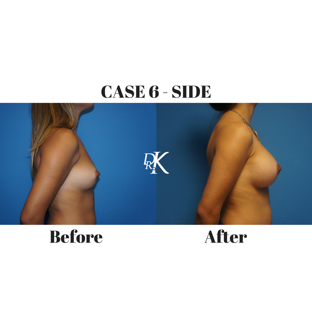 CASE 6 - SIDE