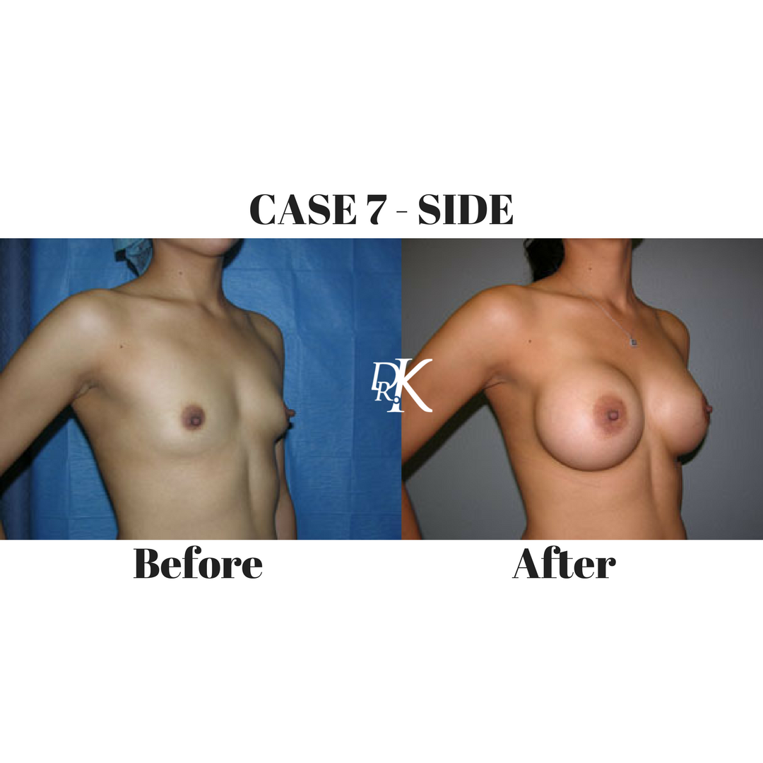 CASE 7 - SIDE