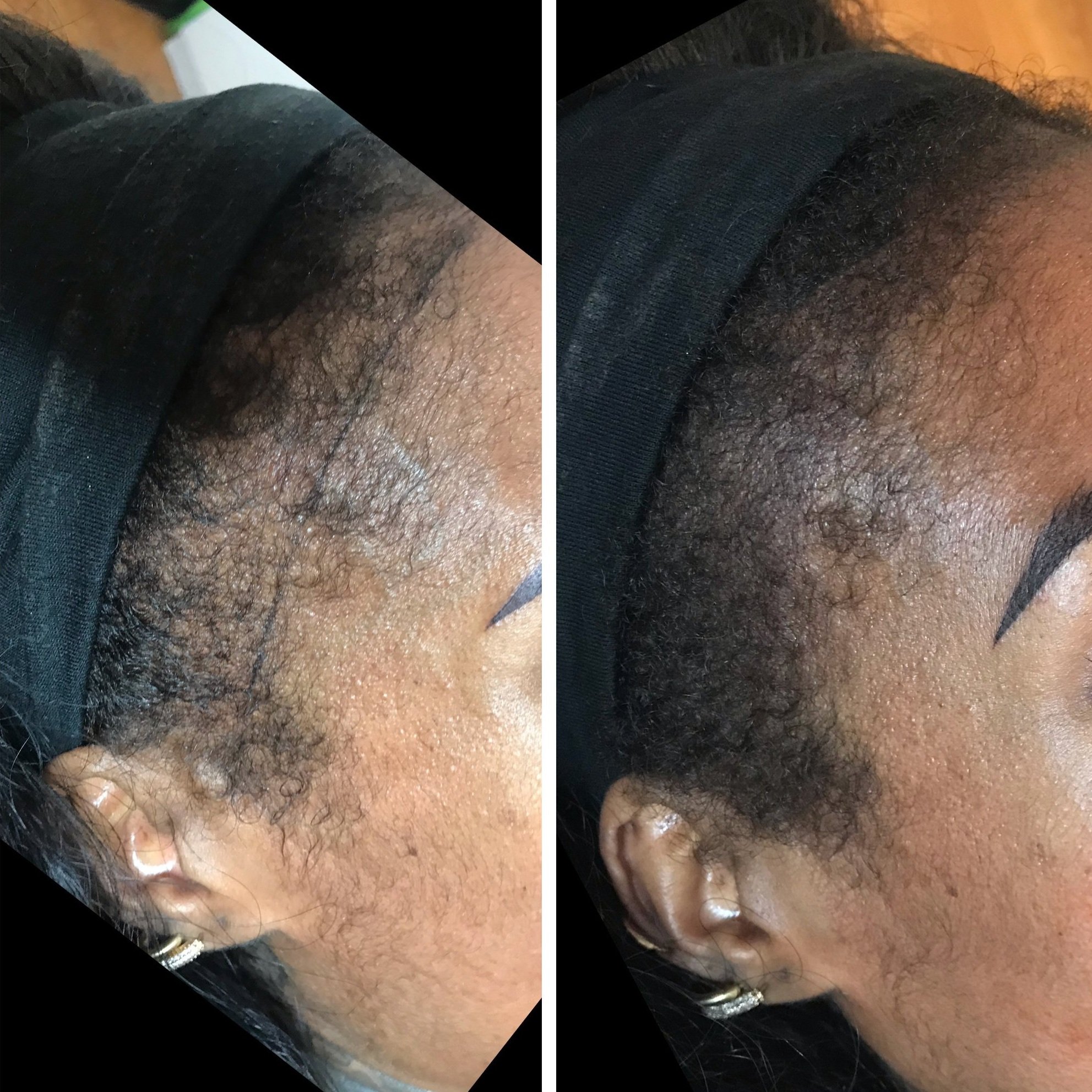 What Is Scalp Micropigmentation and Why Is it So Profitable? - Career -  Modern Salon
