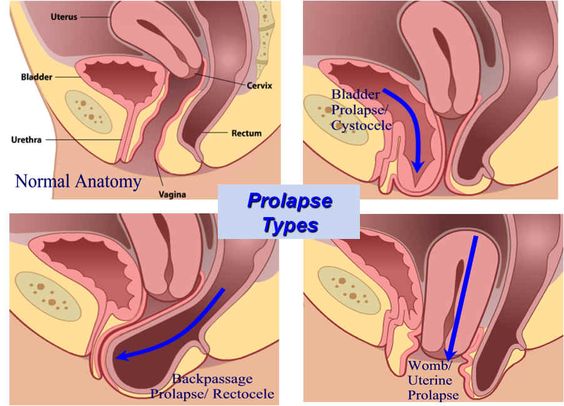 Pelvic Organ Prolapse: 50% of Women Who Have Had Children May Have This —  Empower Your Pelvis