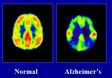 alzheimers.jpg