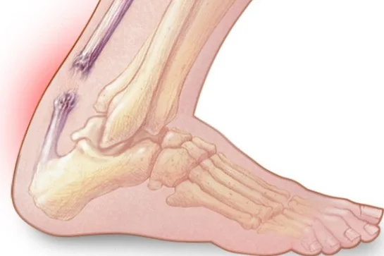 tendon.jpg