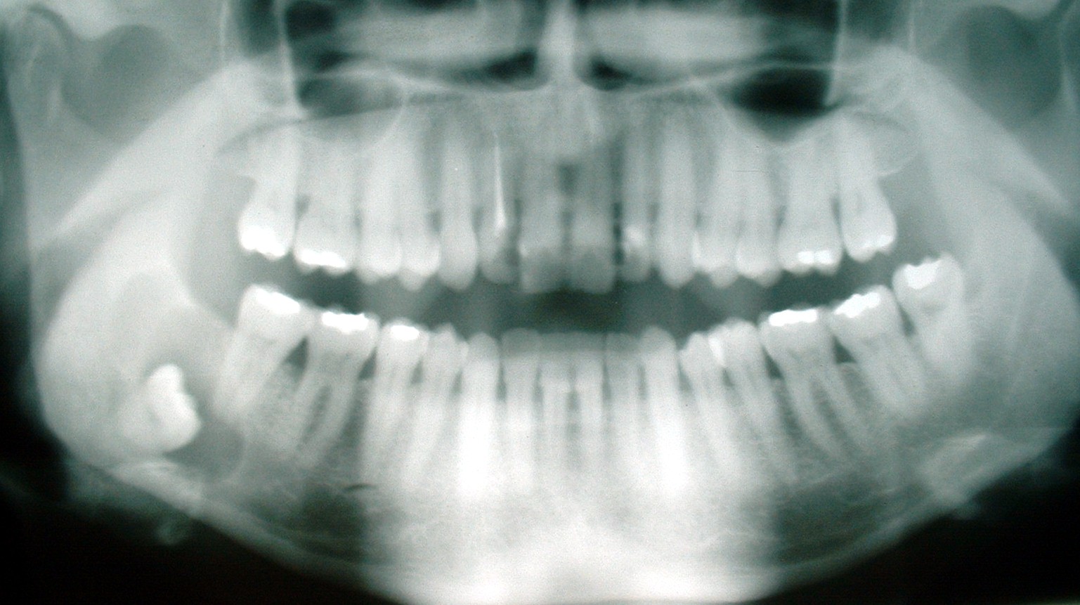 Cyst_-_wisdom_tooth.jpg