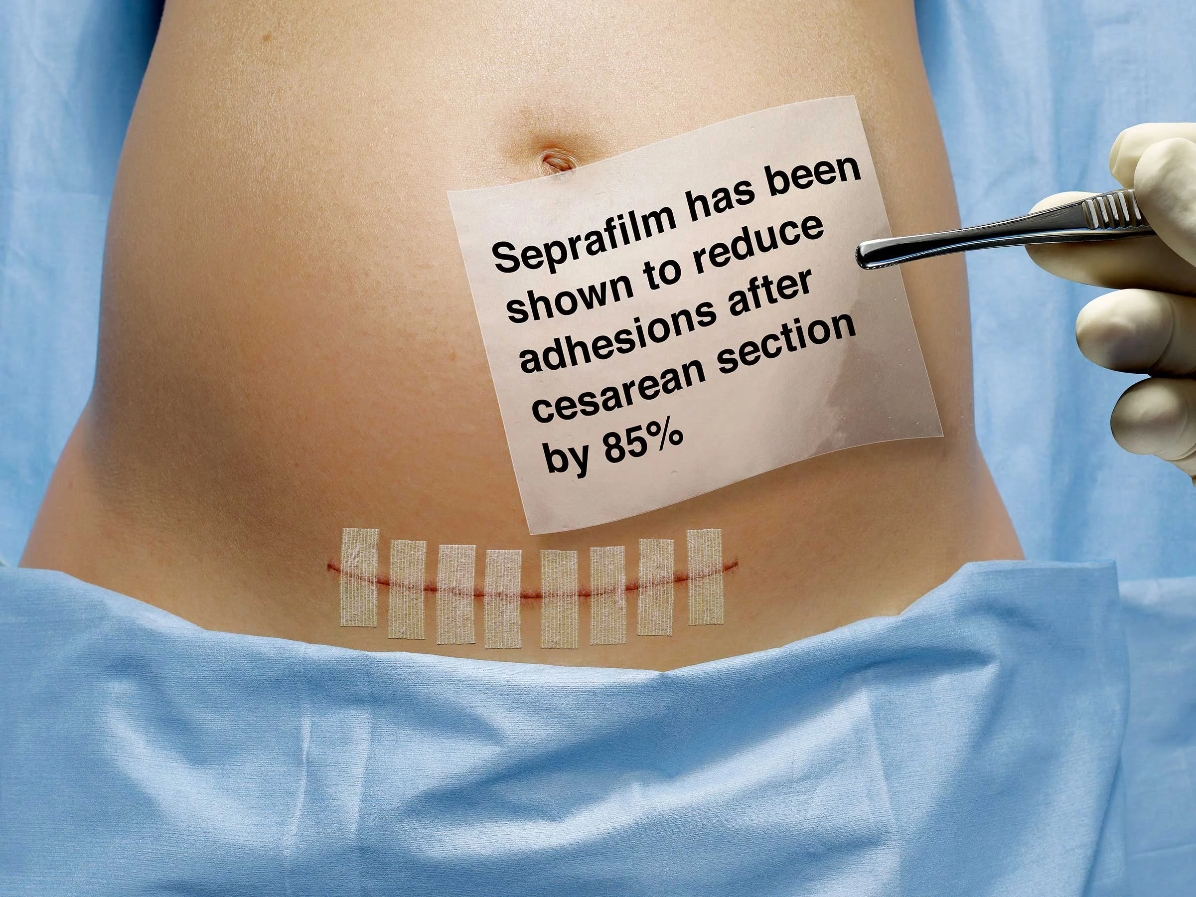 taped-caesarian.jpg