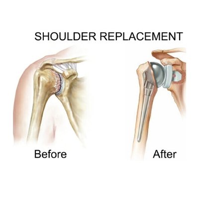 total-shoulder-replacement.jpeg