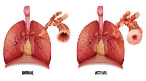 Asthma 