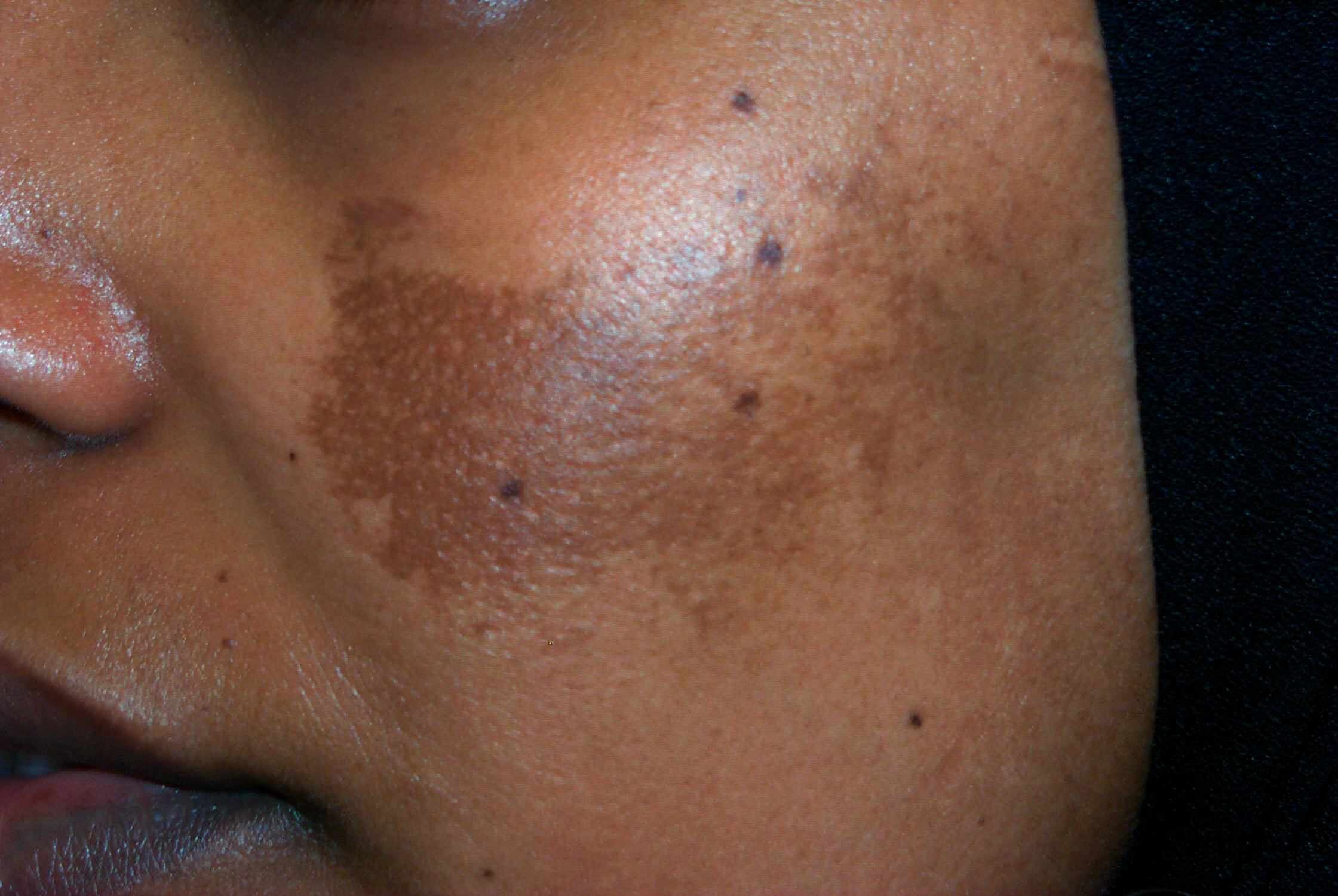 2 Common Pigmentation Issues for POC