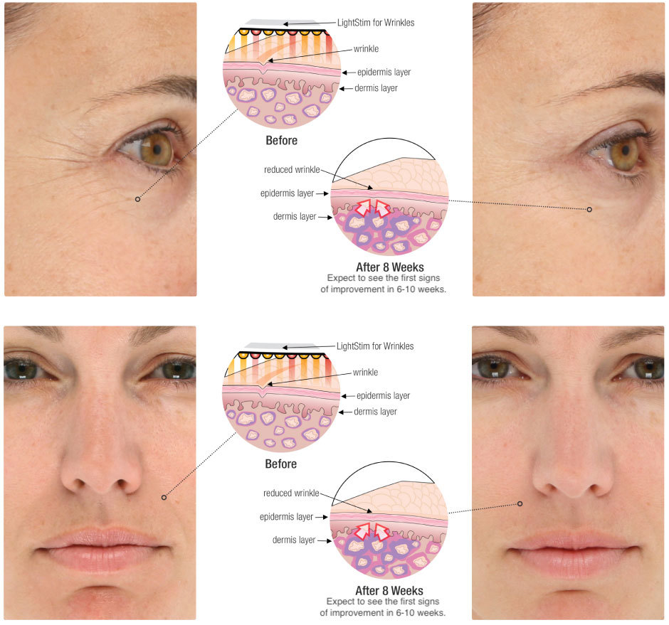 lightstim-wrinkles-before-and-after.png