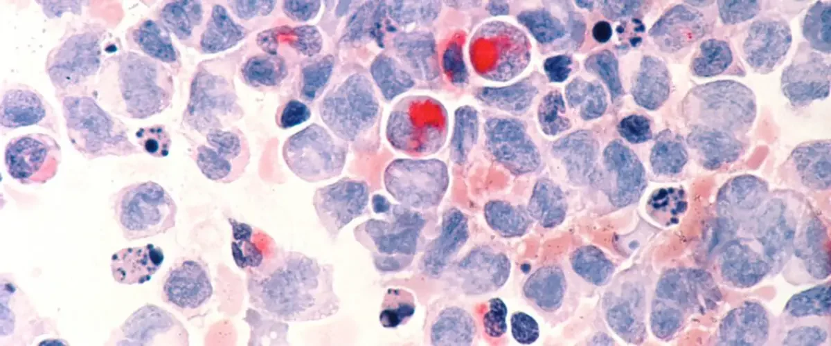 blood cancer cells