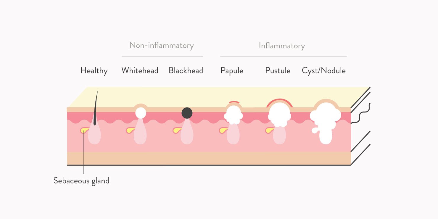 Image courtesy of Curology.com