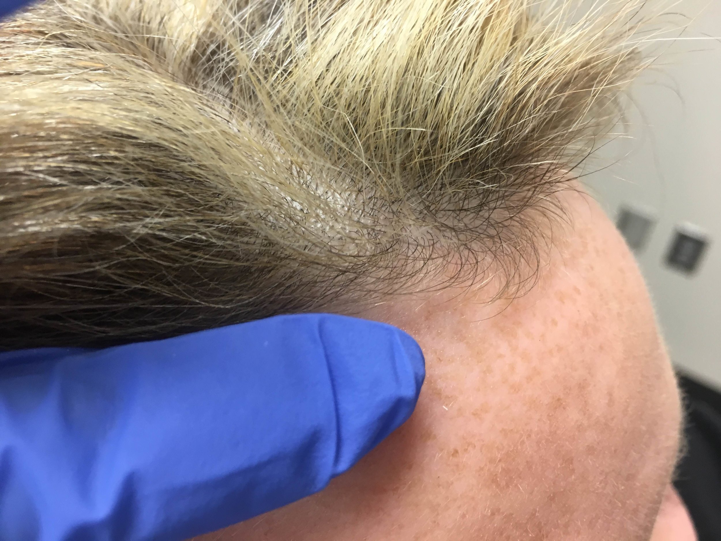 Hair Loss and PRP Injections — Traceside Dermatology and Allergy