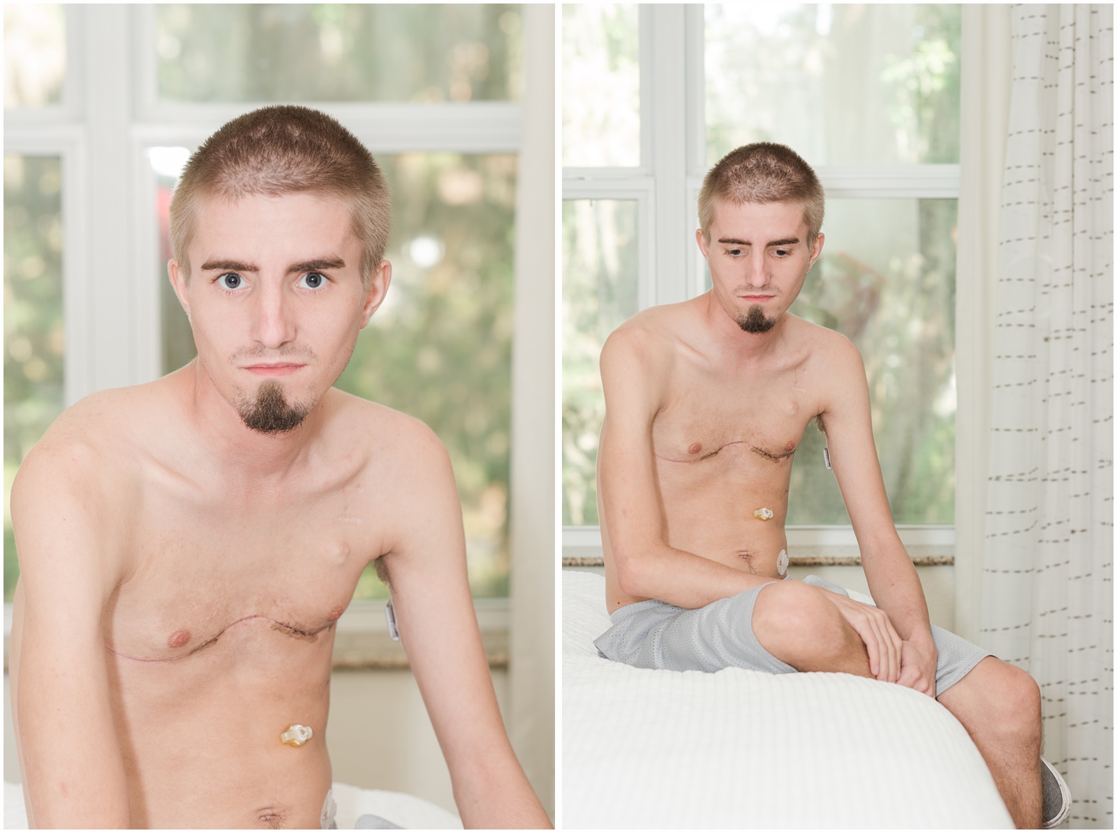 Lung_Transplant_Shands_Hospital_Cystic_Fibrosis_7.jpg