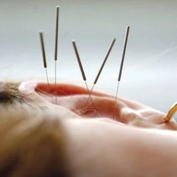 Ear Acupuncture