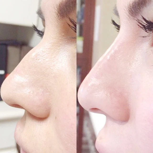 before-after-fillers-nyc