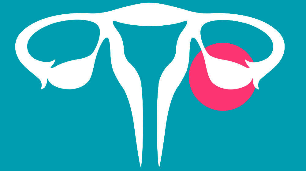 ....Schematische Zeichnung von Gebärmutterkörper, Eileiter und Eierstock (rubinrot eingekreist). ..Schematic drawing of the uterus, fallopian tubes and ovaries (highlighted in red). ....