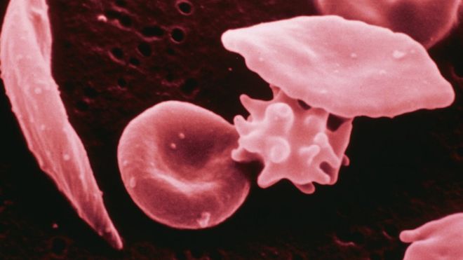 Healthy red blood cells are round, but the genetic defect makes them sickle shaped