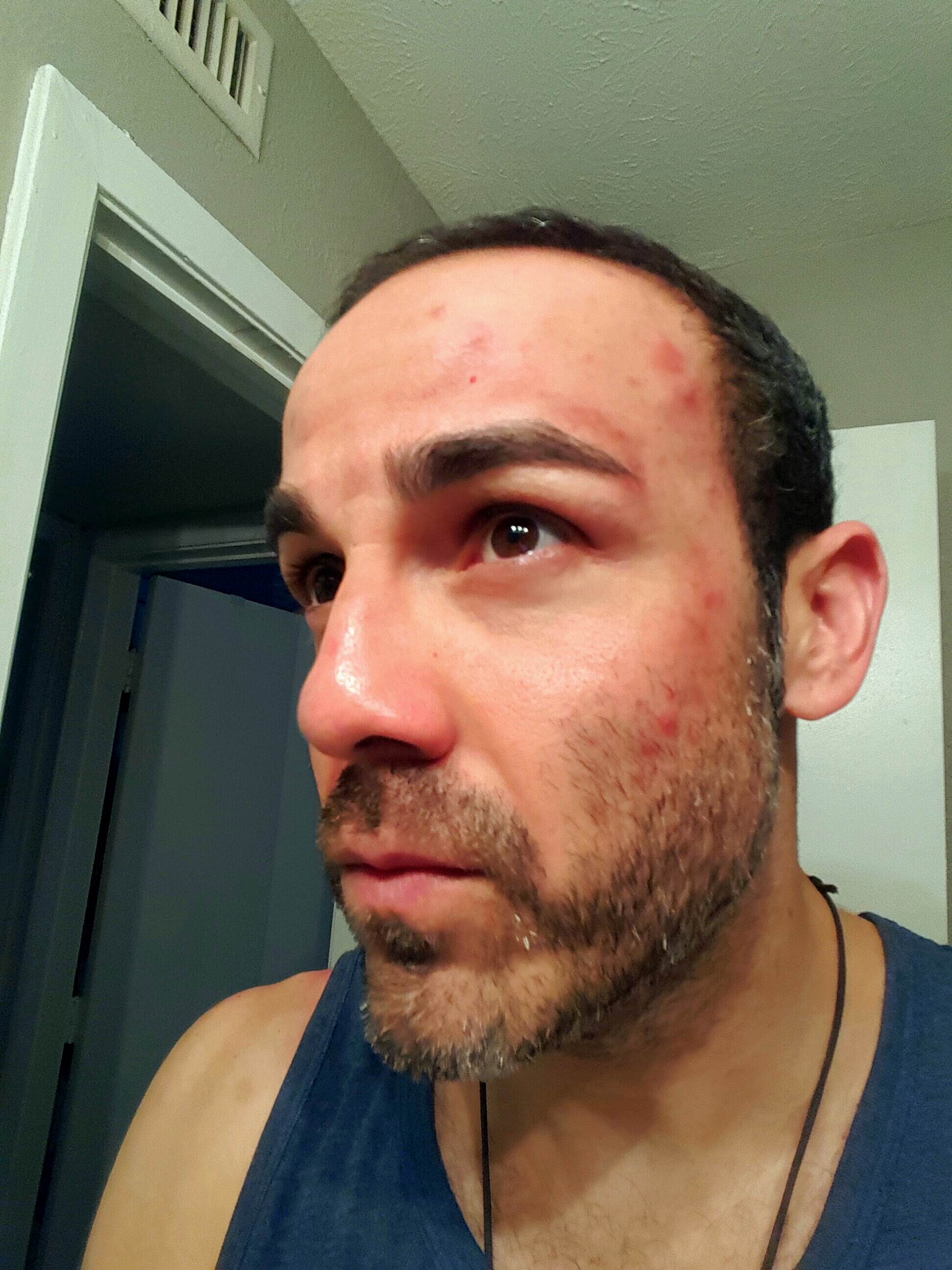 While on the meds my entire face was red and chapped. 