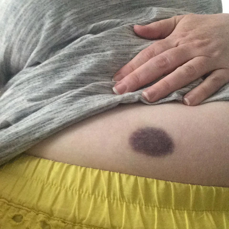 A bruise from one of my shots in my abdomen