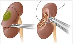 partial nephrectomy.jpg
