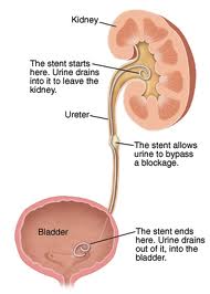 Cystoscopy, Retrograde Pyelogram (RPG) and Insertion of Stent — Gold Coast Urology Cystoscopy, Retrograde Pyelogram (RPG) and Insertion of Stent — Gold Coast Urology