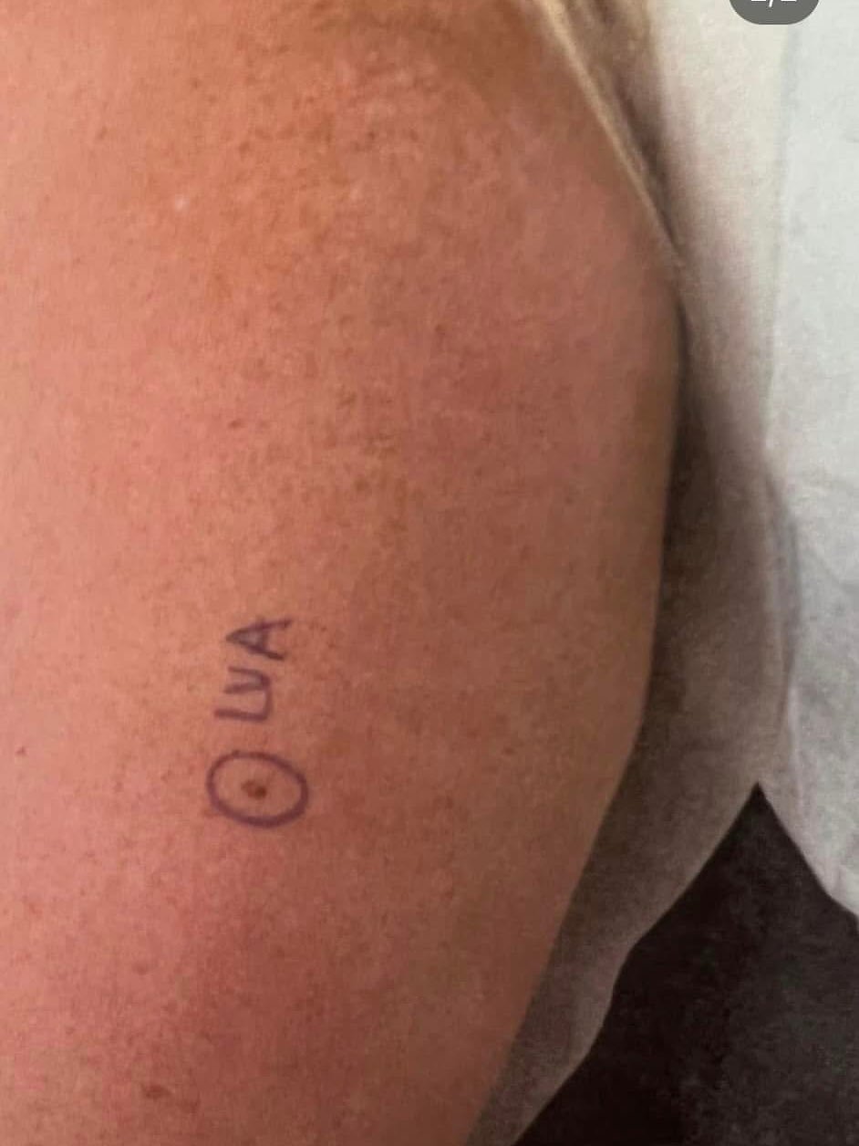 Hi humans! This is your annual reminder to get your skin checked - it could save your life!
.
3 years ago, I got my skin checked - that little freckle in the pic circled was melanoma. My dr said if they would&rsquo;ve found it 1-2 weeks later, I woul