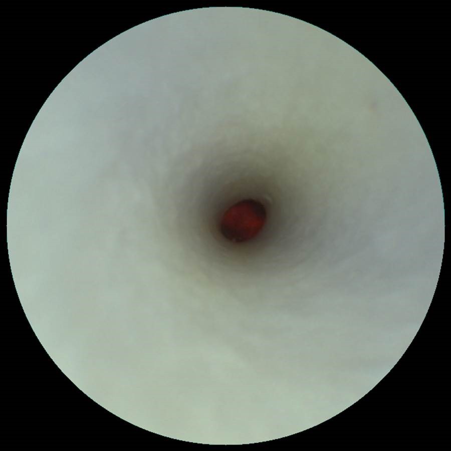 Inside the artery (away from thrombus)