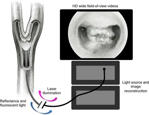 Research: A Multimodal Intravascular Imager for Carotid Atherosclerosis