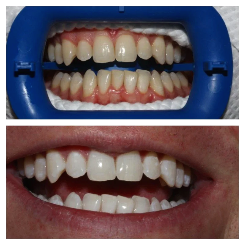 Comparison at Brisbane Smile Boutique of teeth before and after dental treatment, showing improved alignment and whitening in the lower set of teeth.