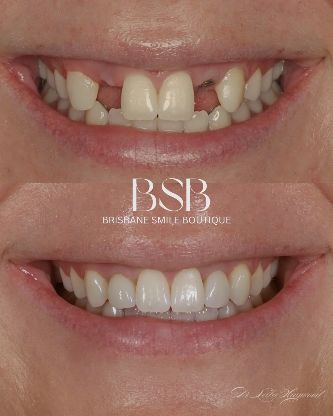 before and after photos of a female smile with missing teeth and after photo of Advanced Implant Dentistry in Spring Hill at Brisbane Smile Boutique