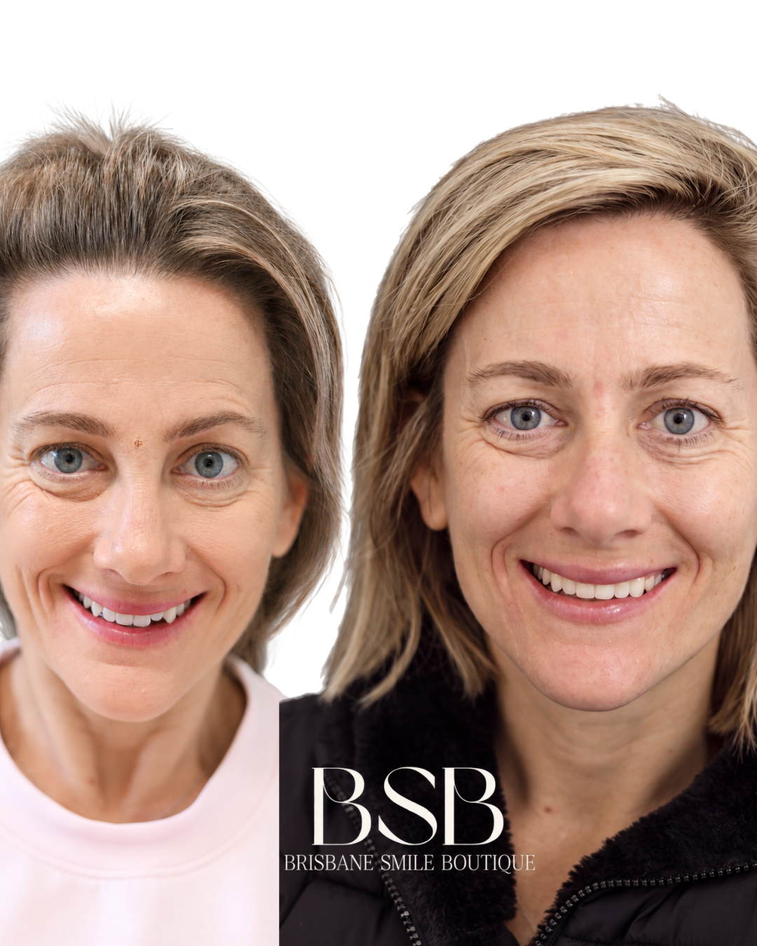 before and after image of a woman after invisaign teeth straightening and composite resin bonding