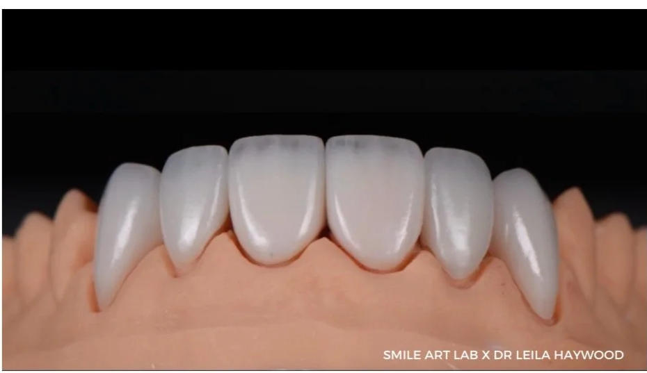 Handcrafted Veneer Creation with layered porcelain veneers on a lab model