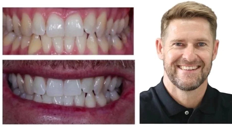 Comparison images of a man's smile at Brisbane Smile Boutique of a man's teeth before and after dental treatment showing improved teeth alignment in the lower image, next to a smiling man in a black polo shirt, with cosmetic dentistry.