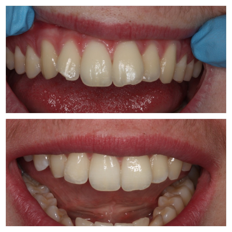 Resin Veneers