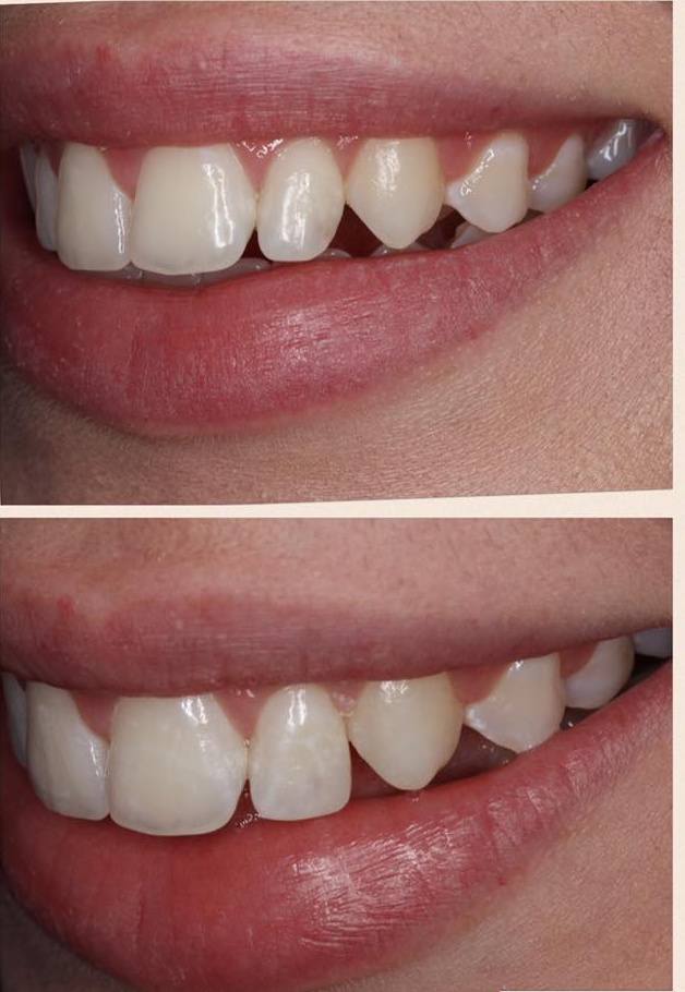 Composite tooth bonding