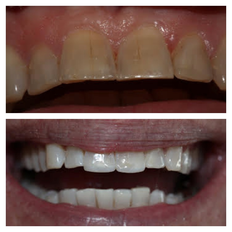 Teeth bonding and whitening