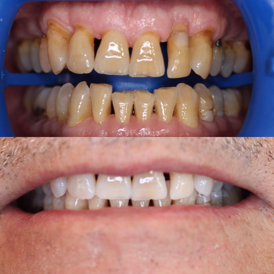 Teeth whitening Brisbane