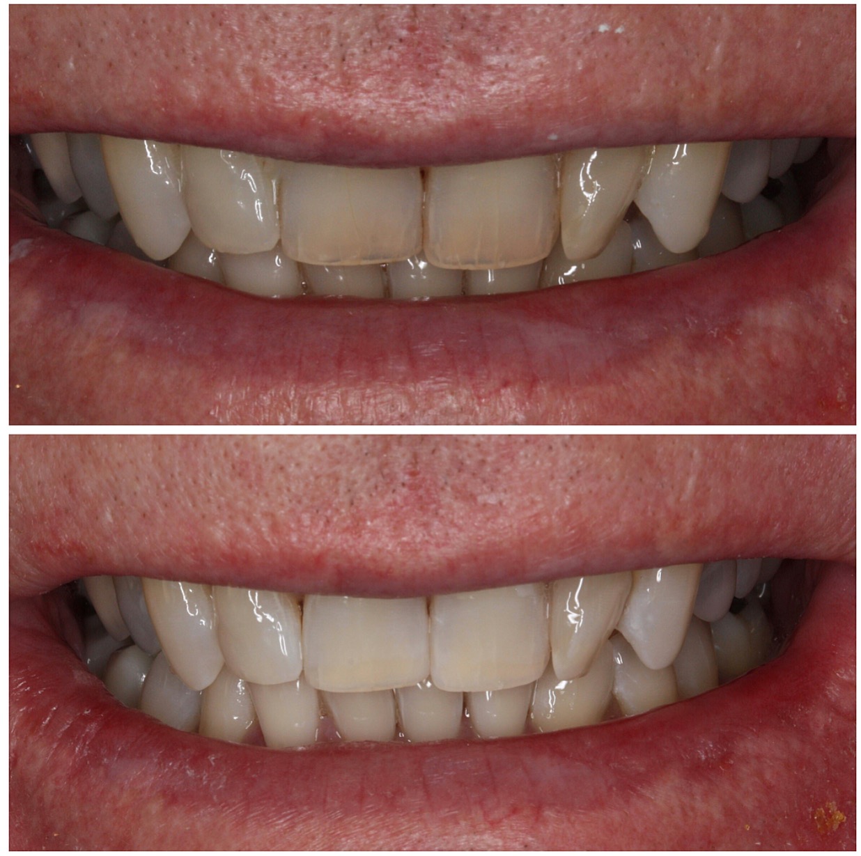 Tooth whitening Brisbane