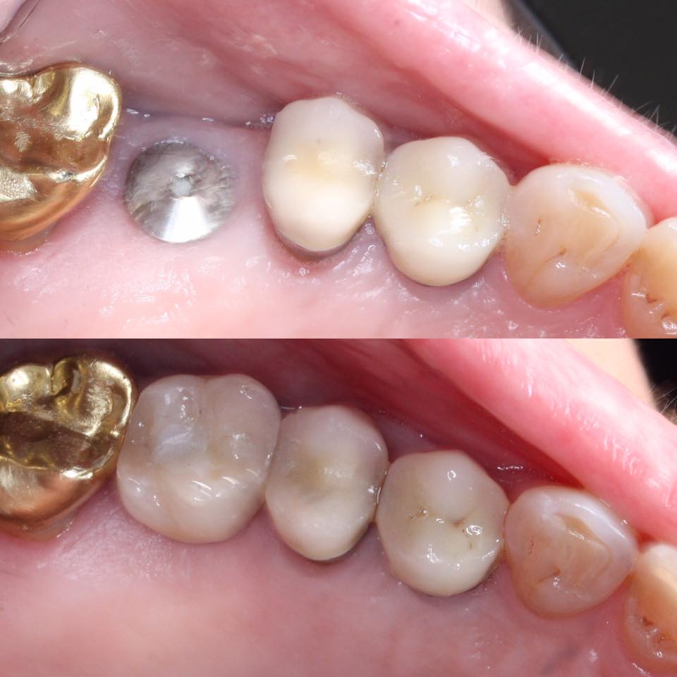 Dental implant for a molar tooth