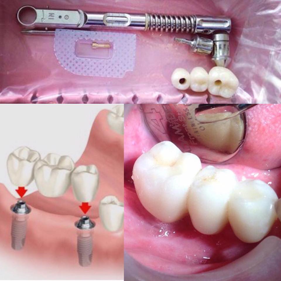 Dental Implant bridge 