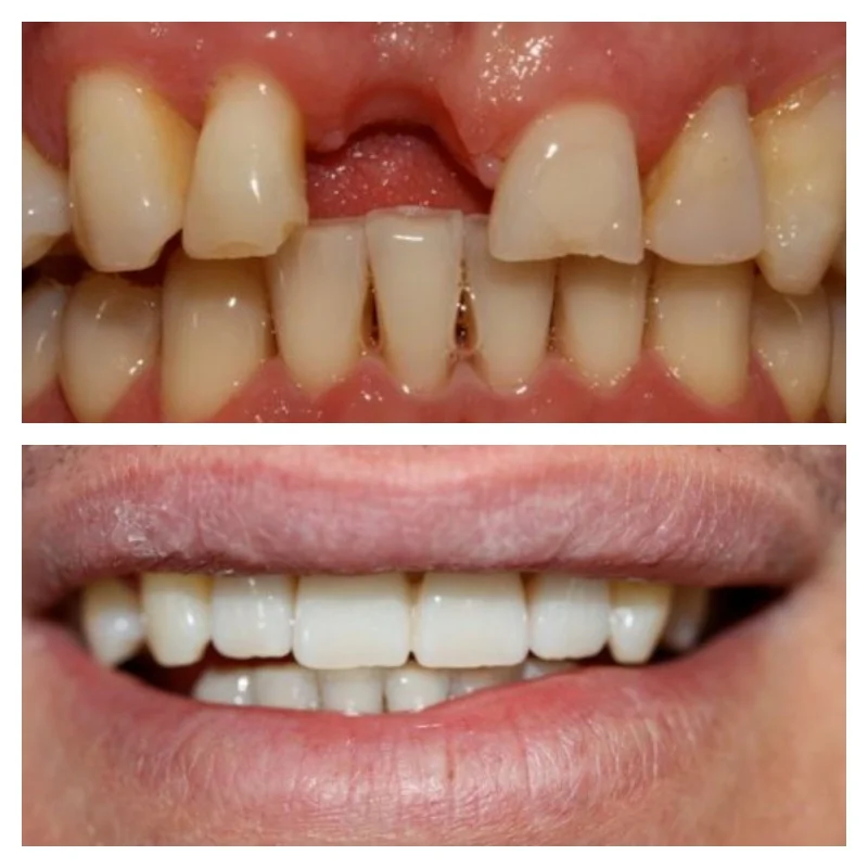 before and after images at Brisbane Smile Boutique of dental bridge restoration