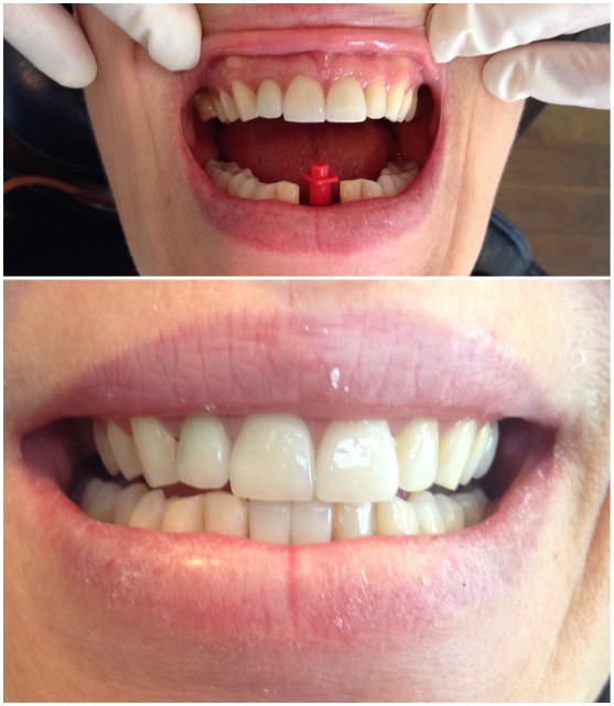 Porcelain Veneers and Dental Implants in Brisbane 