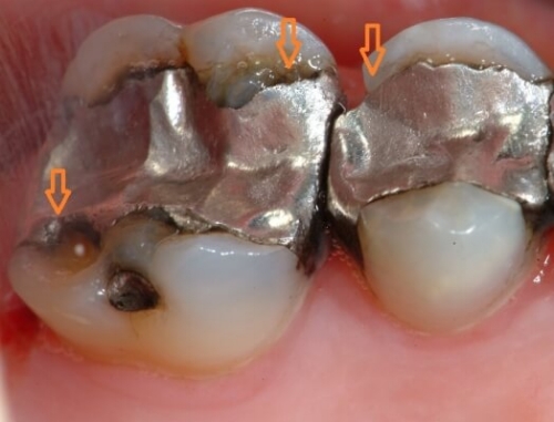 amalgam+problem.jpeg