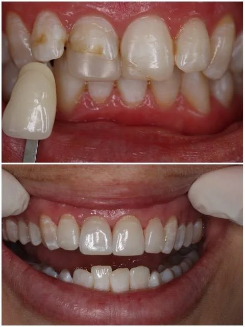 Porcelain veneers