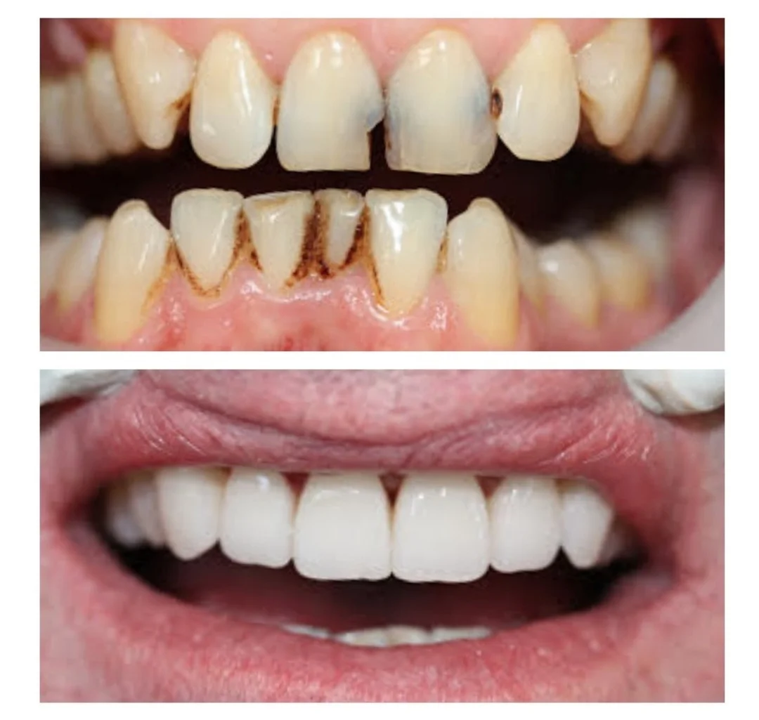 Dental Crowns at Brisbane Smile Boutique Dentists Brisbane Smile