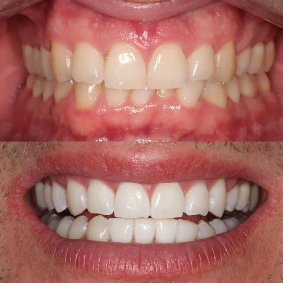Teeth Whitening before and after photo comparison