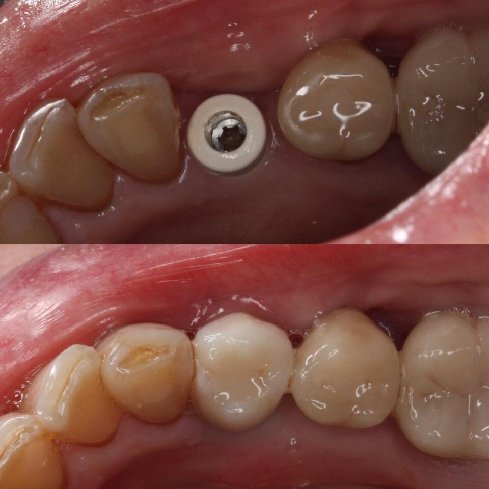 Lower premolar implant 