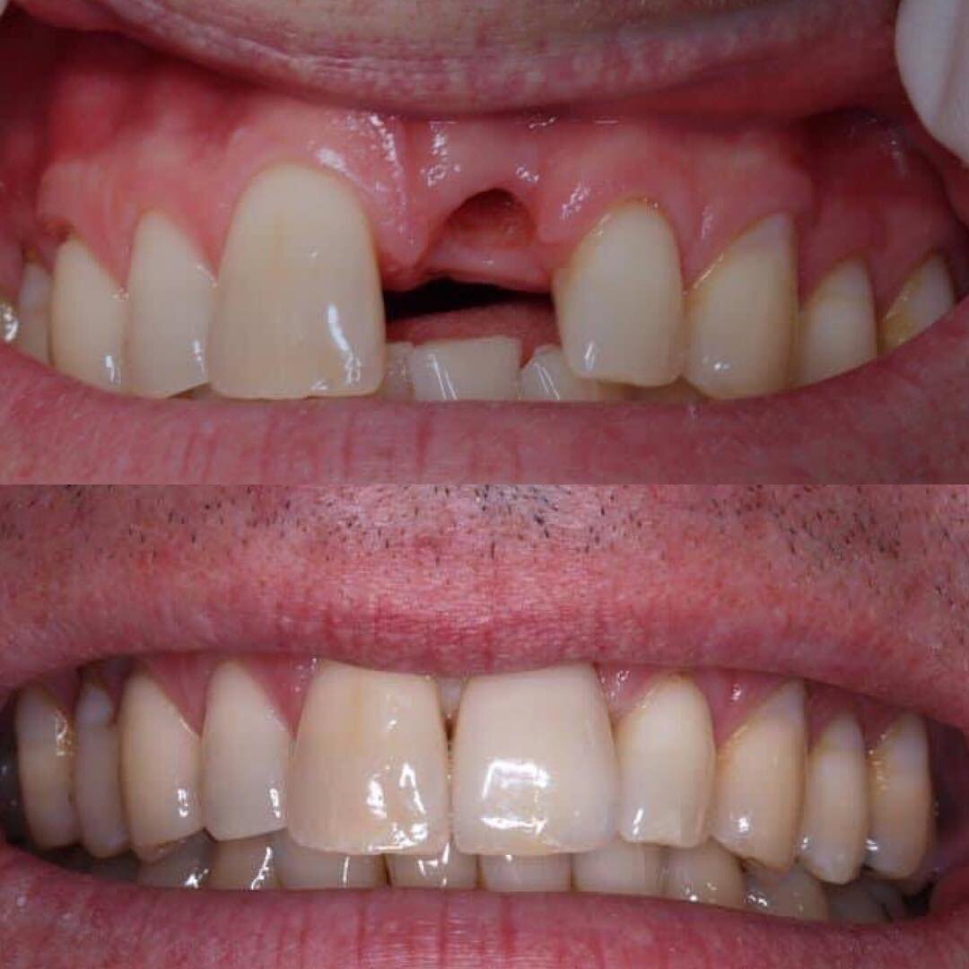 Implant replacement for front tooth